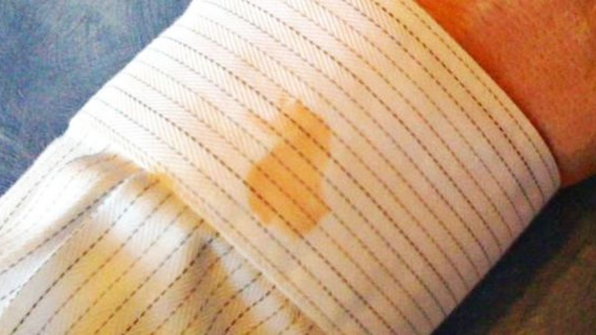 kan-lekesi-nasil-cikarr