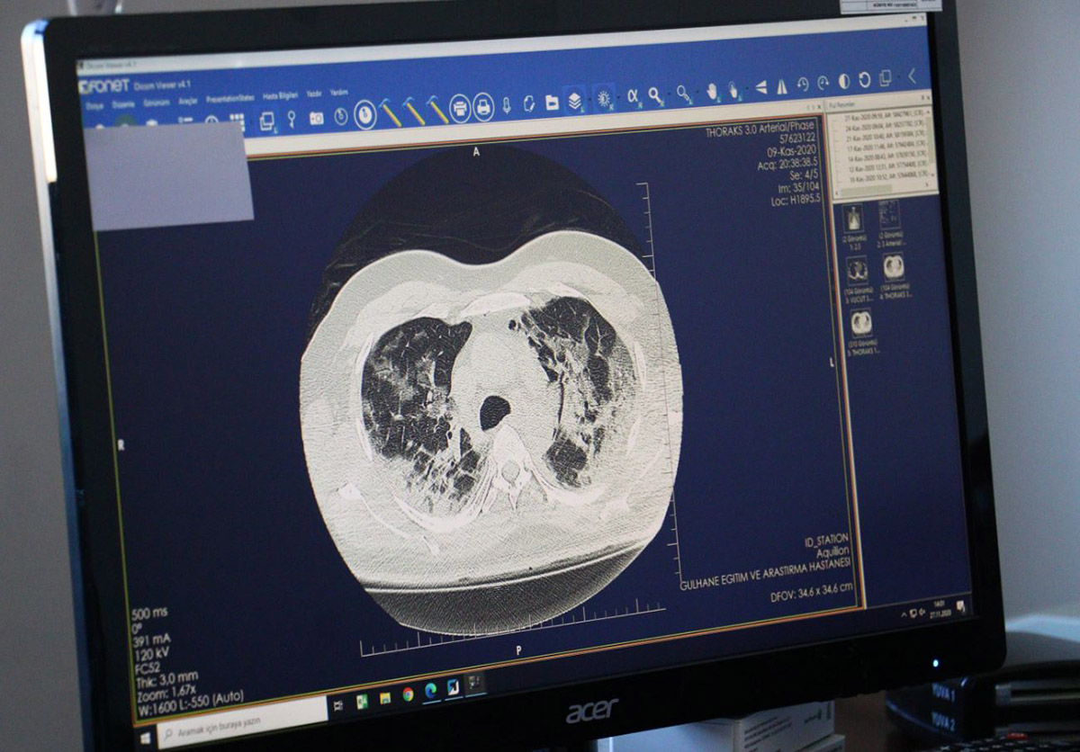 covid-19un-akcigerdeki-hasari-tomografi-goruntulerinde-2400-dhaphoto2