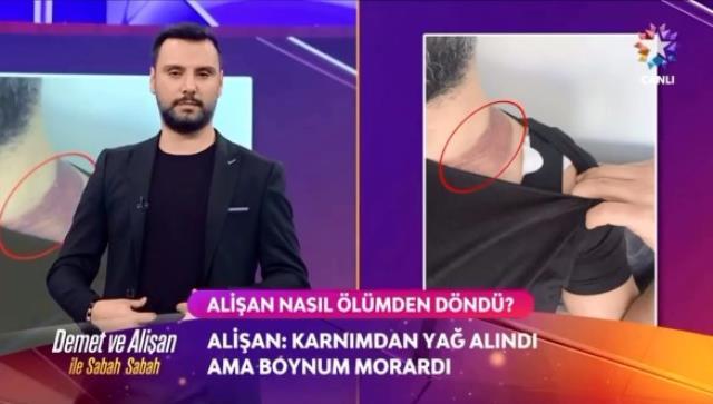 yaglarini aldiran sarkici alisan