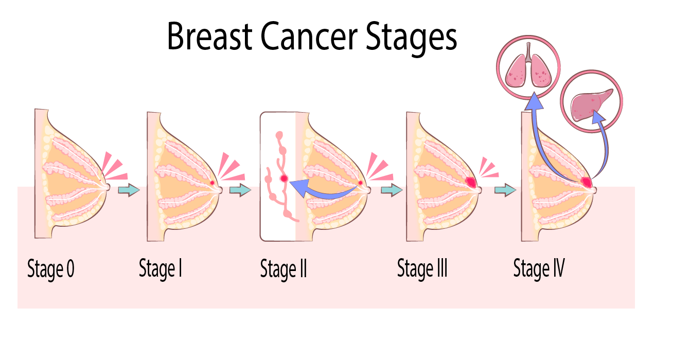 breastcancerstages