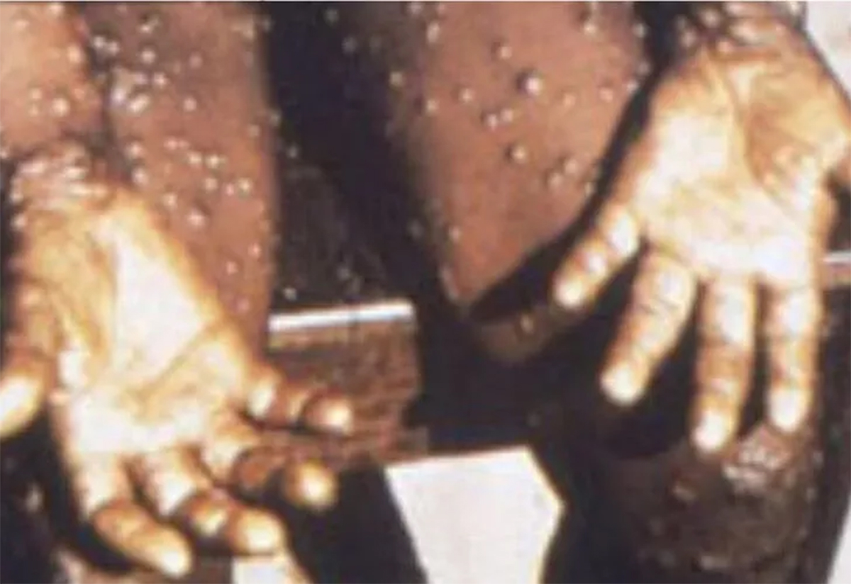 maymun-cicegi-virusu-ingiltere