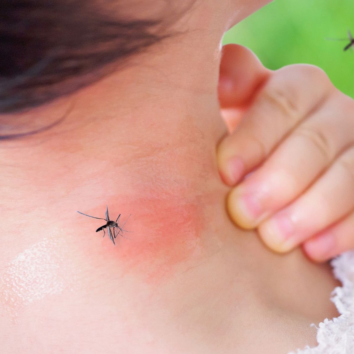 0-cute-asian-baby-girl-has-rash-and-allergy-on-neck-skin-from-mosquito-bite-and-sucking-blood-while-pl