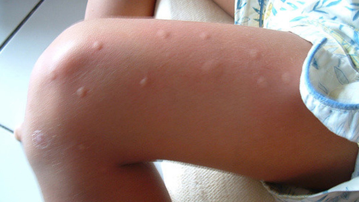mosquito-bites-1296x728-gallery-slide1