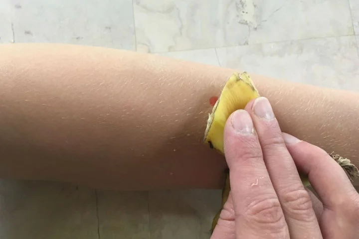 muz-kabugu-sinek-isirigi