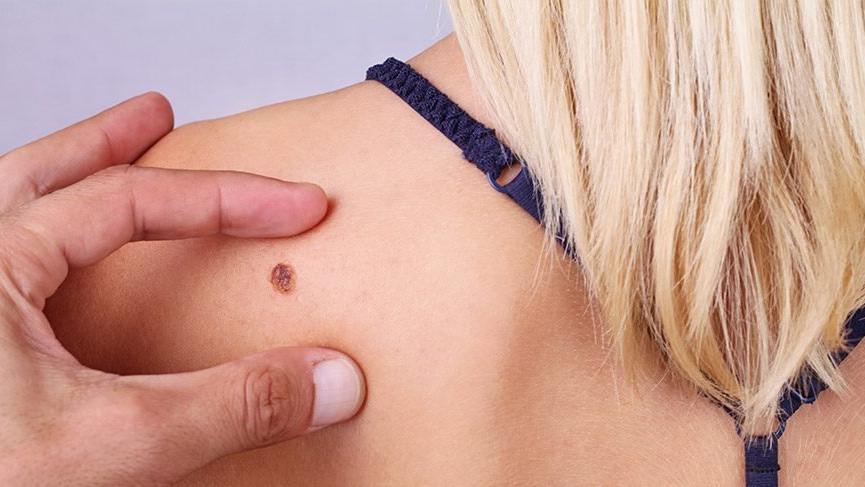 cilk-kanseri-sozcu-16-9-1546843278