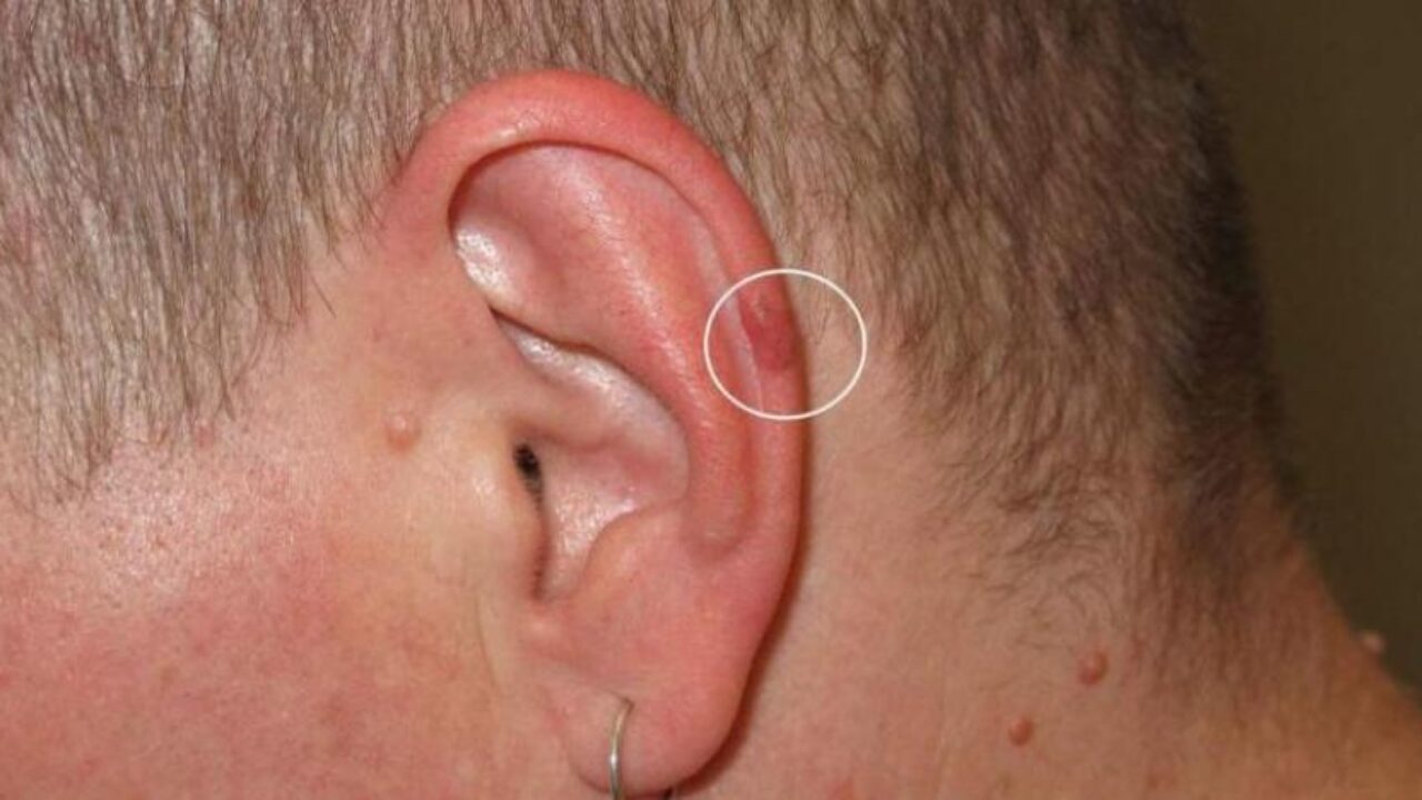 cilt-kanseri-1280x720