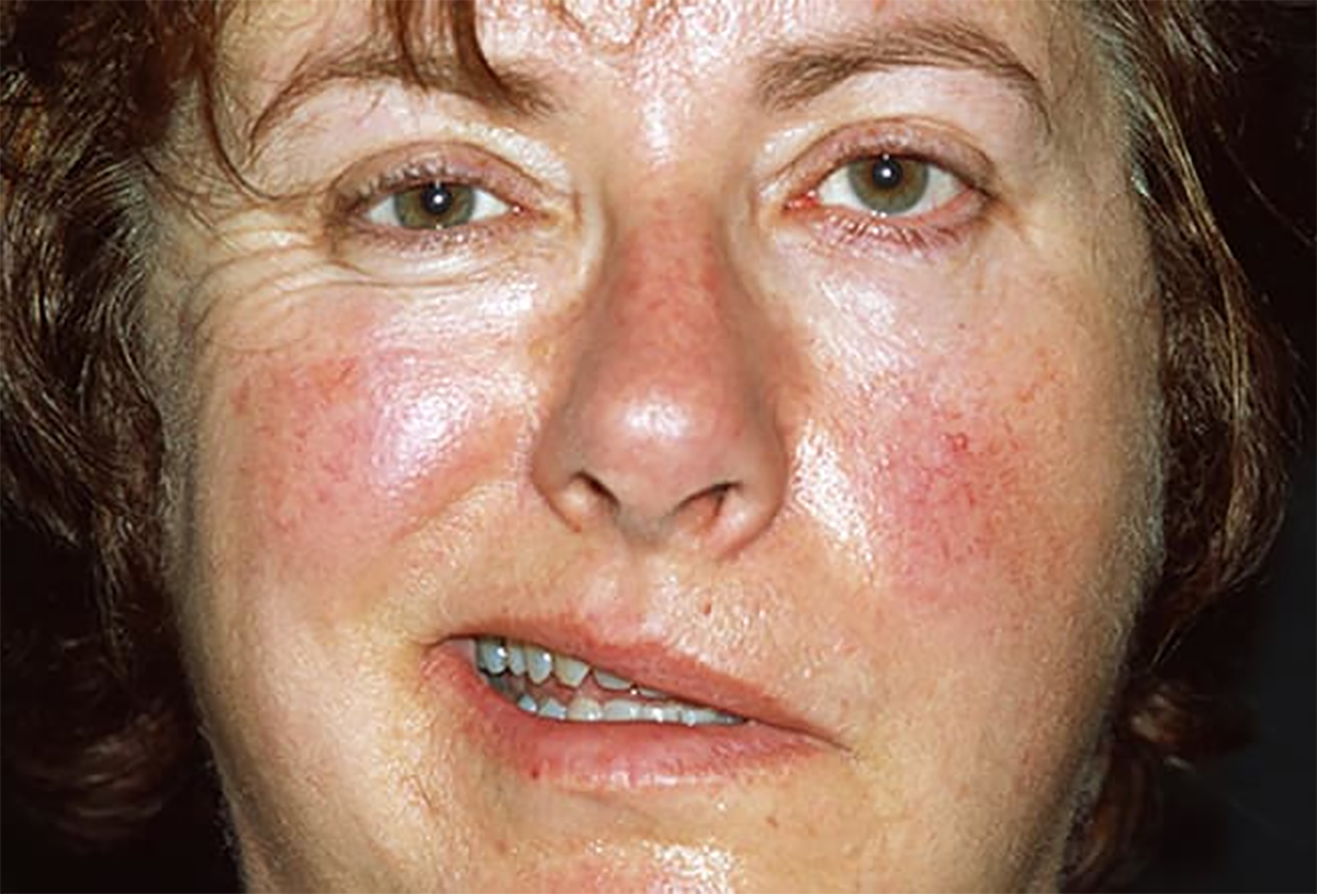 yuzunuz-ve-hastalik-8