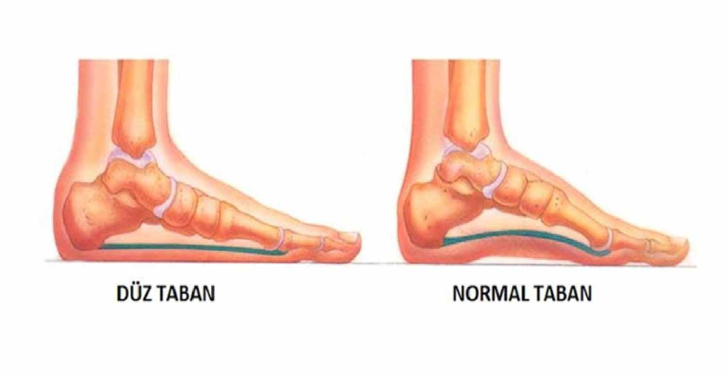 Düztabanlık nedir?