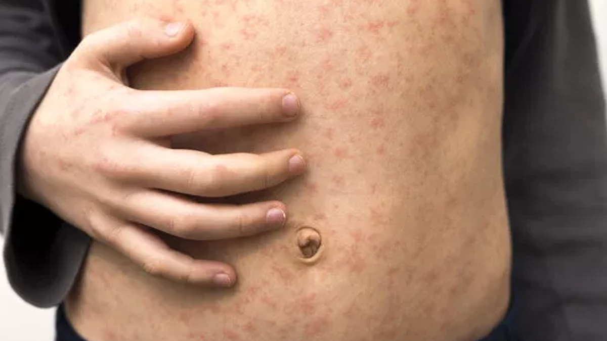 domates-gribi-belirtisi