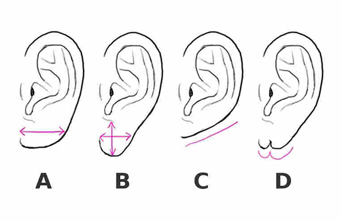 Какие есть уши. Форма ушной раковины и характер человека. Форма мочек ушей и характер человека. Пластика мочки уха схема. Форма ушей их размер и строение.