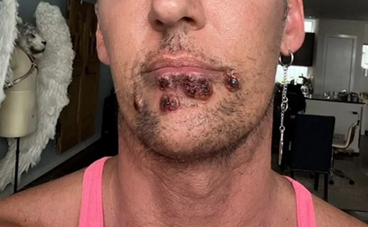 maymun-cicegi-belirtileri