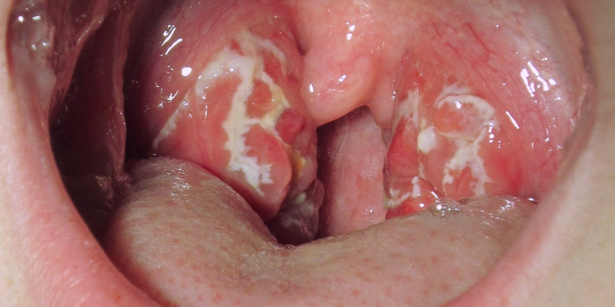 Strep A virüs belirtileri nelerdir