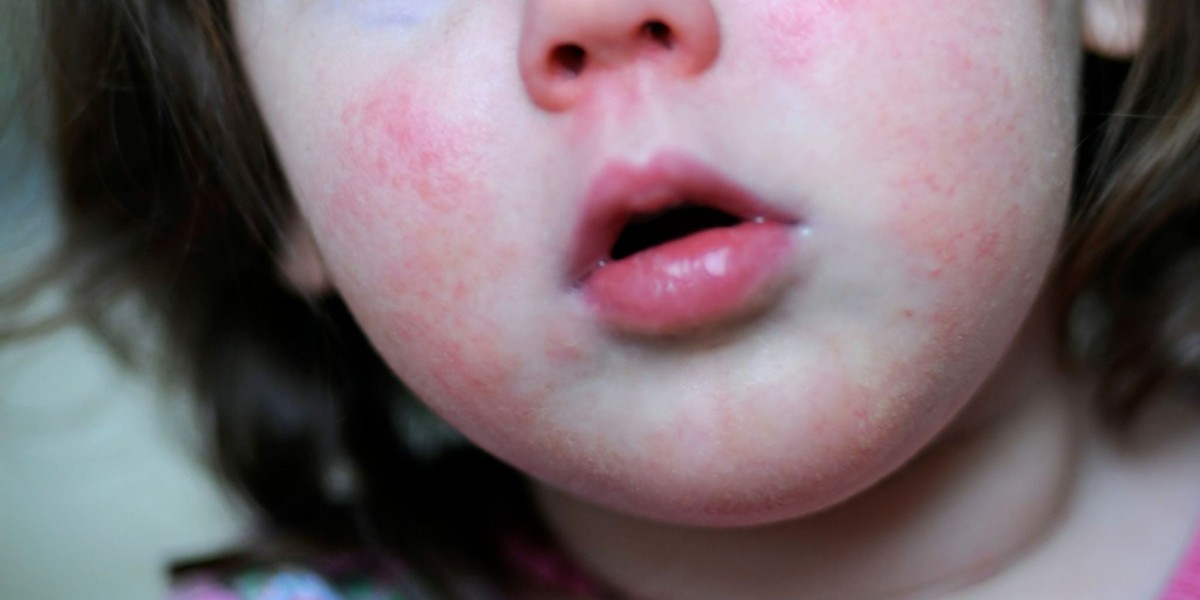 Strep A virüsü nedir