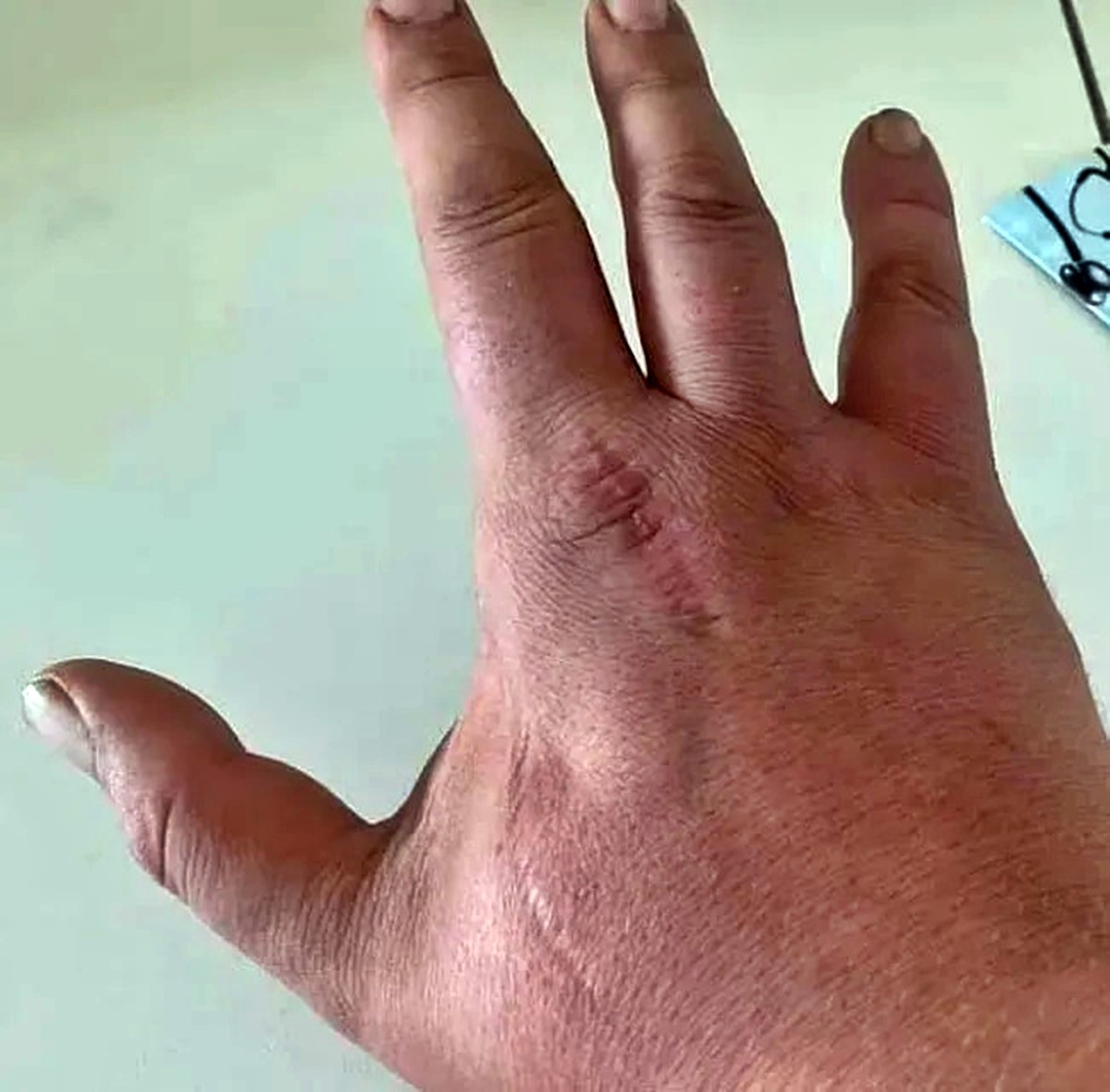 kedinin-isirdigi-adam-oldu-3