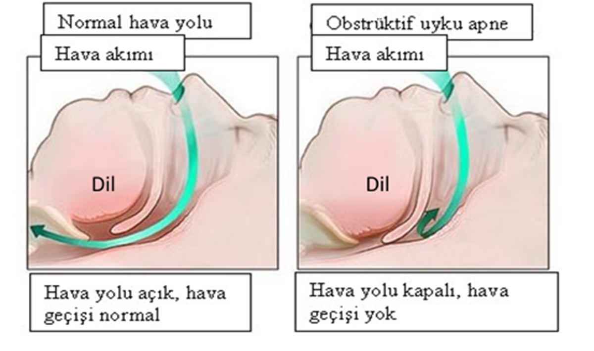 uyku-apnesi-nasil-neden-olur.jpg