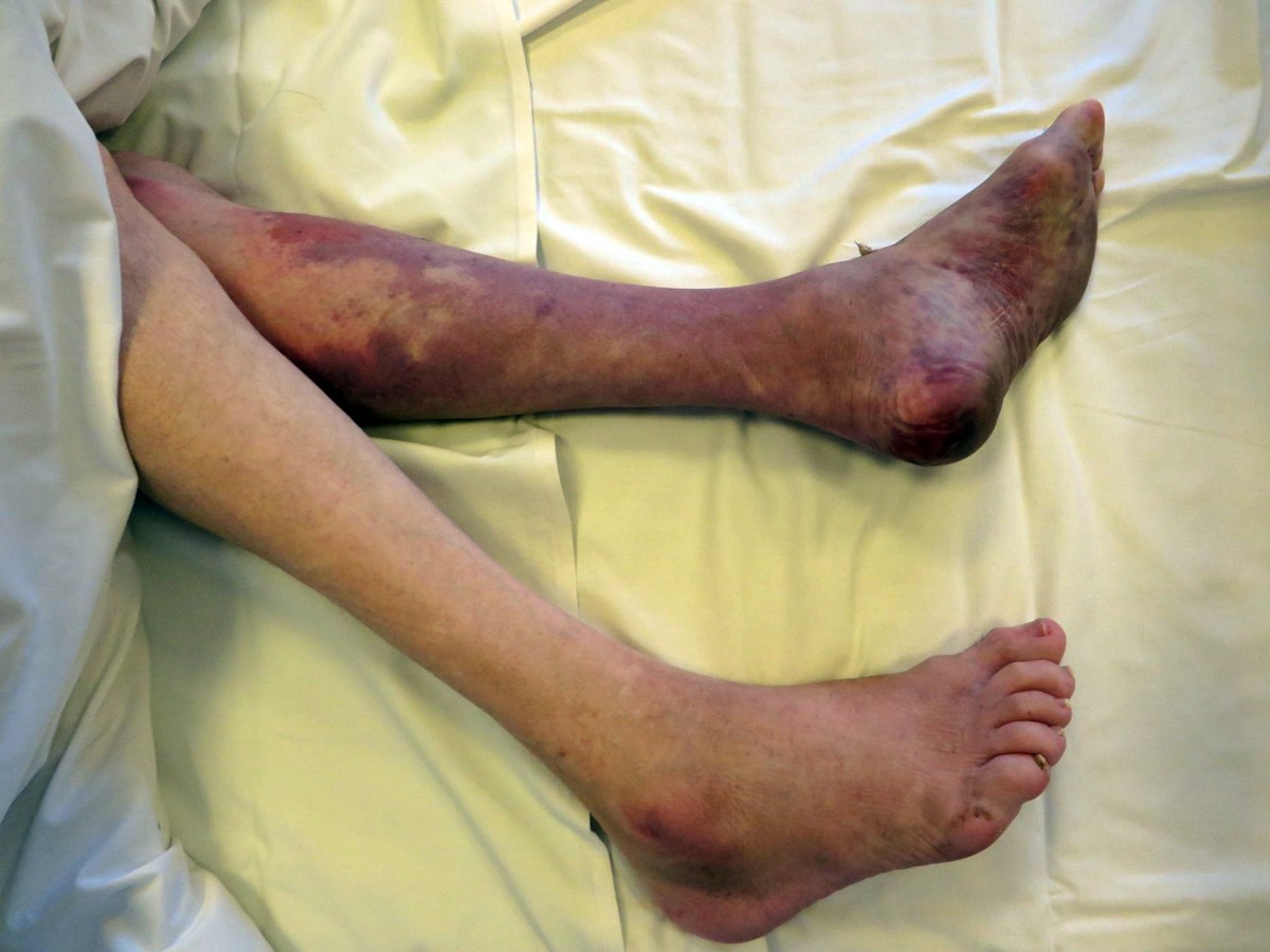 crush-sendromu-nasil-anlasilir