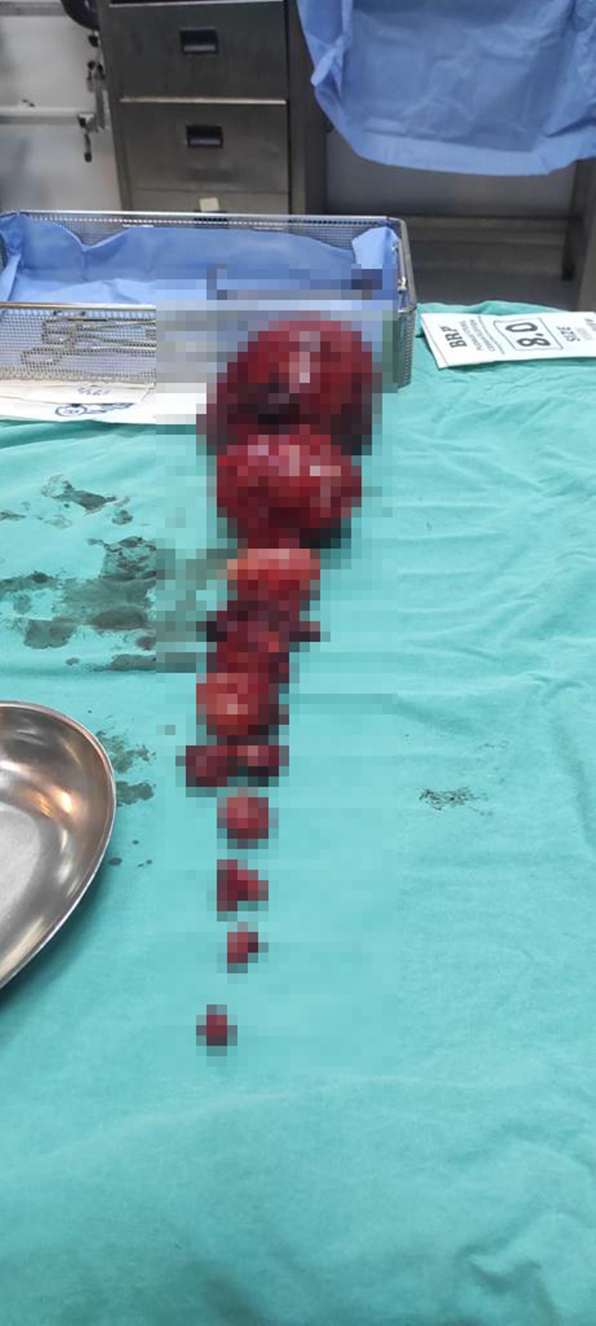 5-kilo-tumor-cikan-kadin-65-aylik-bebek-dogurdu-4