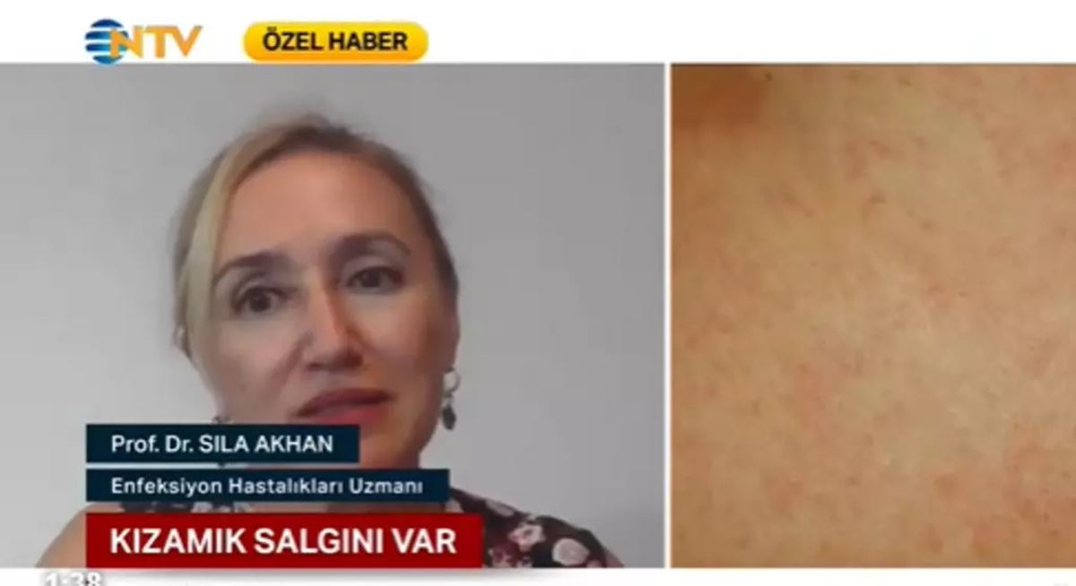 35-yasinda-kizamik-oldu-1