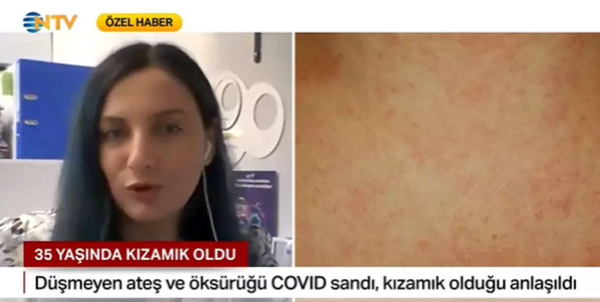 35-yasinda-kizamik-oldu-3