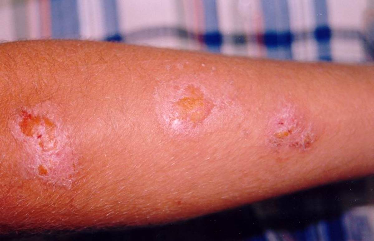 yakagan-sinekleri-zararlari-neler-4