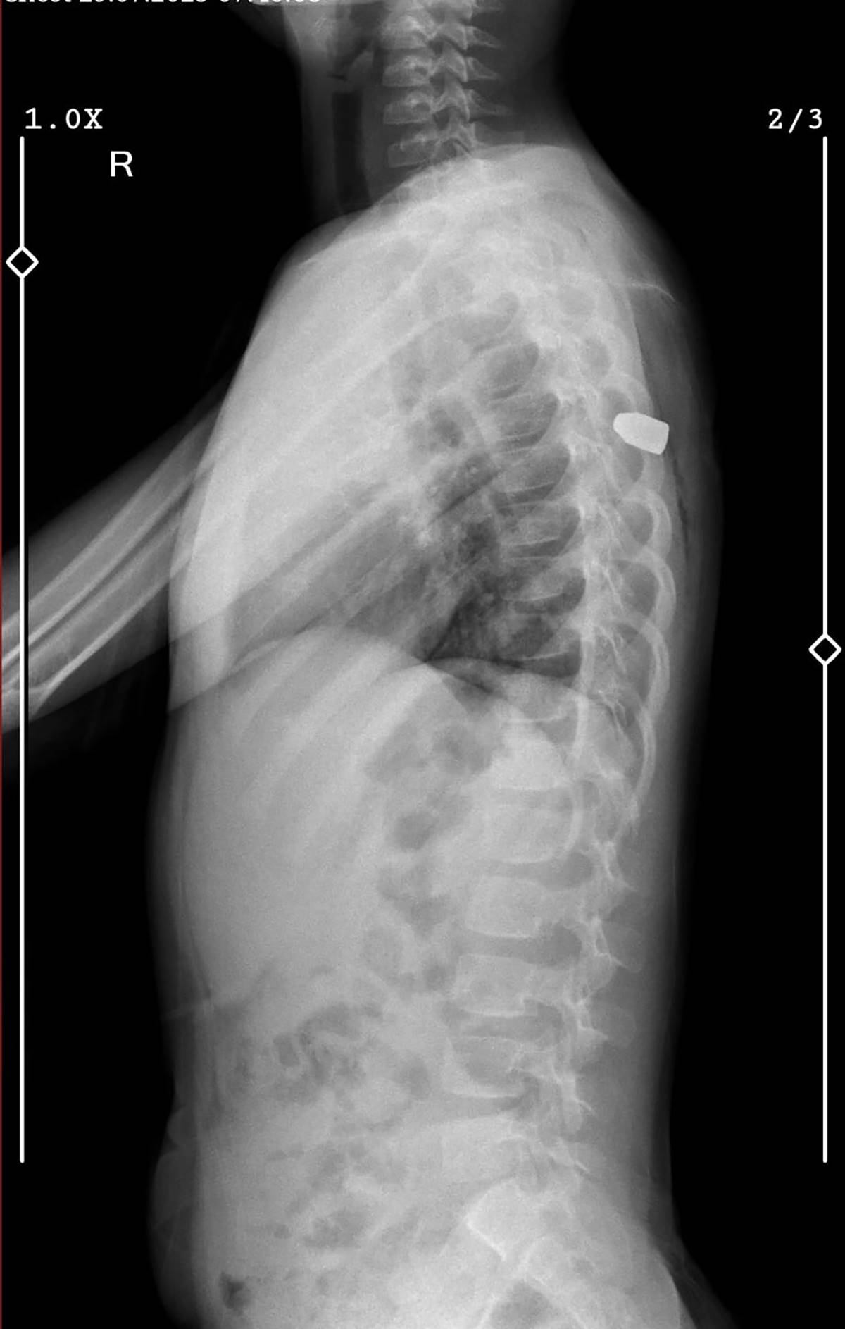 yorgun-mermi-kizin-sirtina-saplandi-3