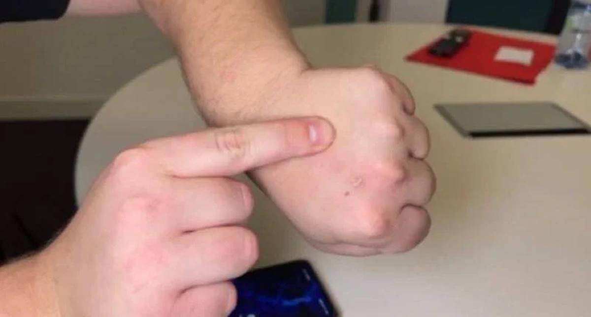 deri-altina-nfc-mikrocip-yerlestirilir-mi-2