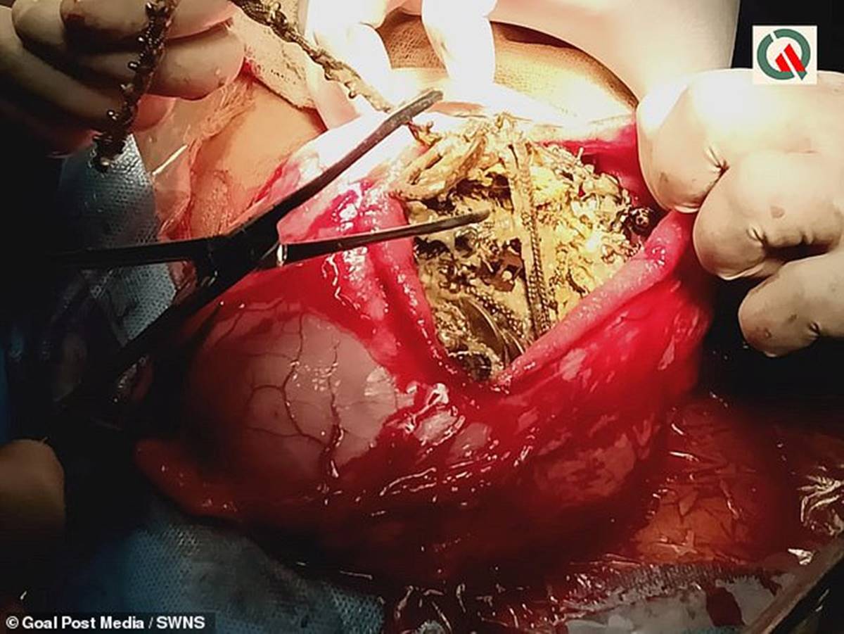 karin-agrisiyla-hastaneye-gitti-midesinden-metal-ve-degerli-esyalar-cikti-2