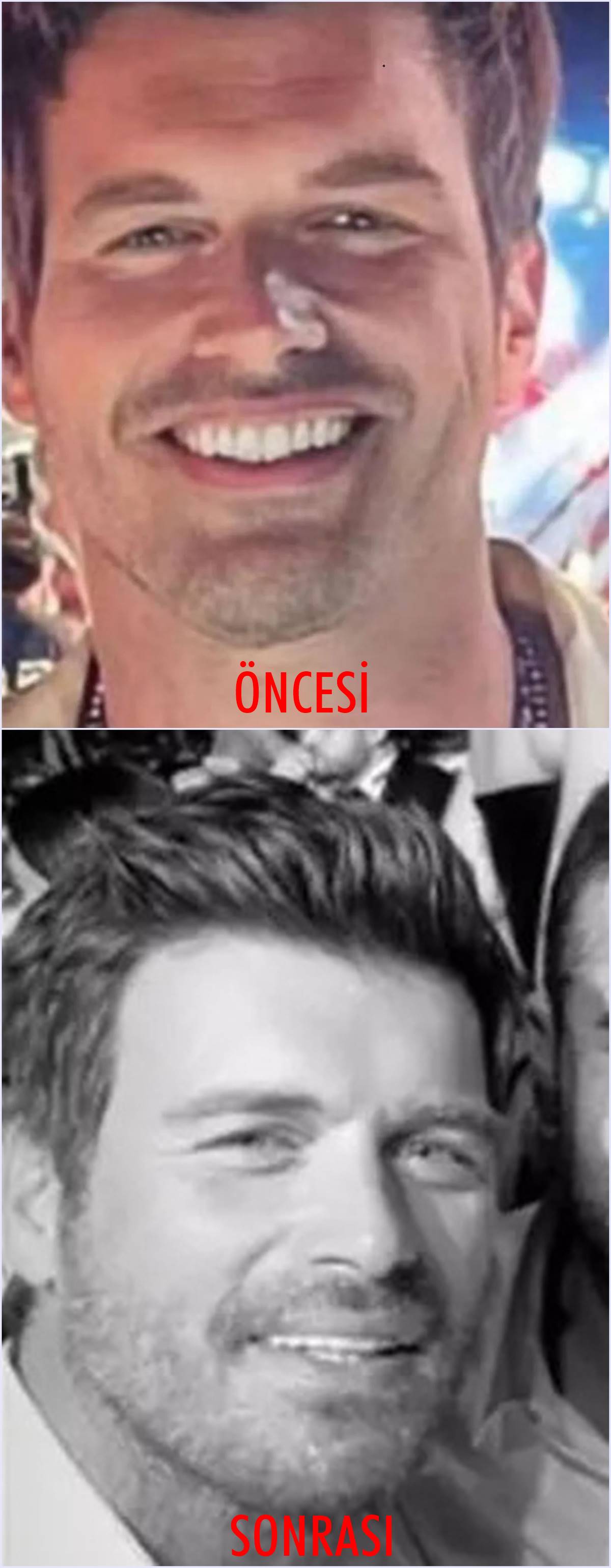 kivanc-tatlitug-estetik-oncesi-sonrasi-foto