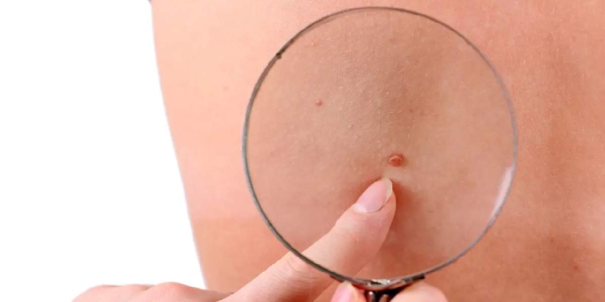 cildindeki-bu-lekeleri-hafife-alan-hayatinin-hatasini-yapar-1