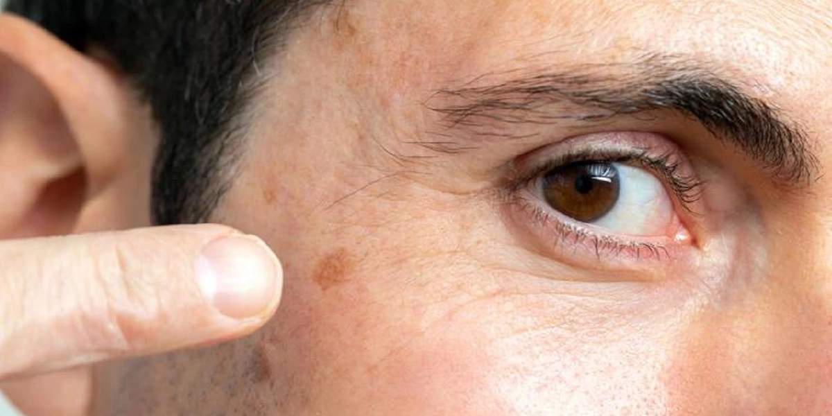 cildindeki-bu-lekeleri-hafife-alan-hayatinin-hatasini-yapar-2