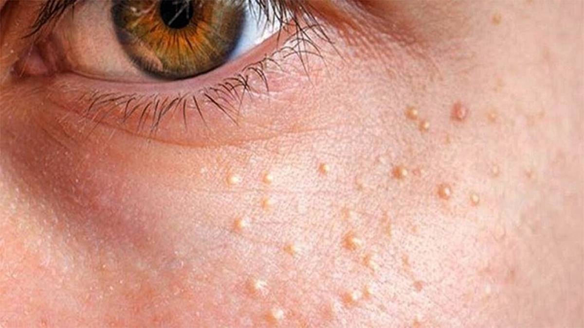 yag-bezesi-dogal-yolla-nasil-gecer