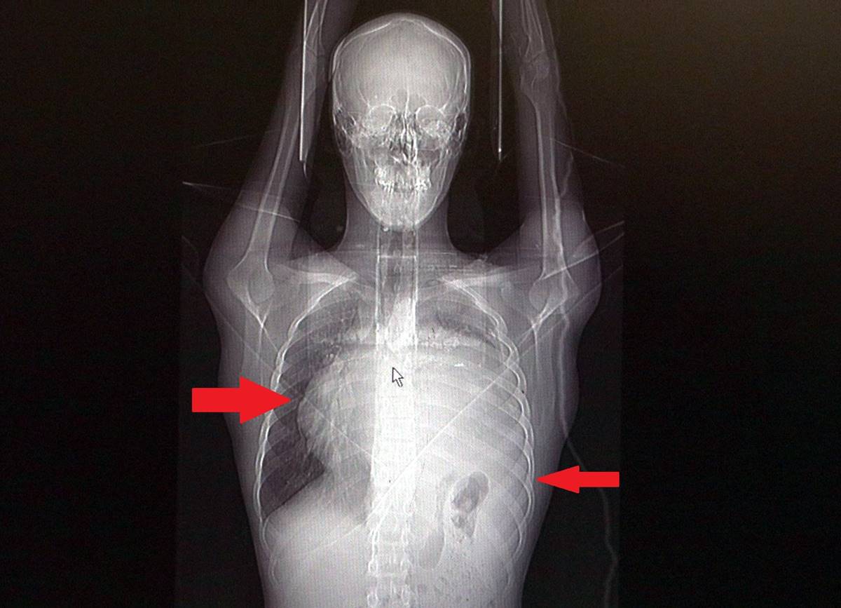kalbi-12-santim-saga-kaydi-dev-tumor-doktorlari-bile-sasirtti-2