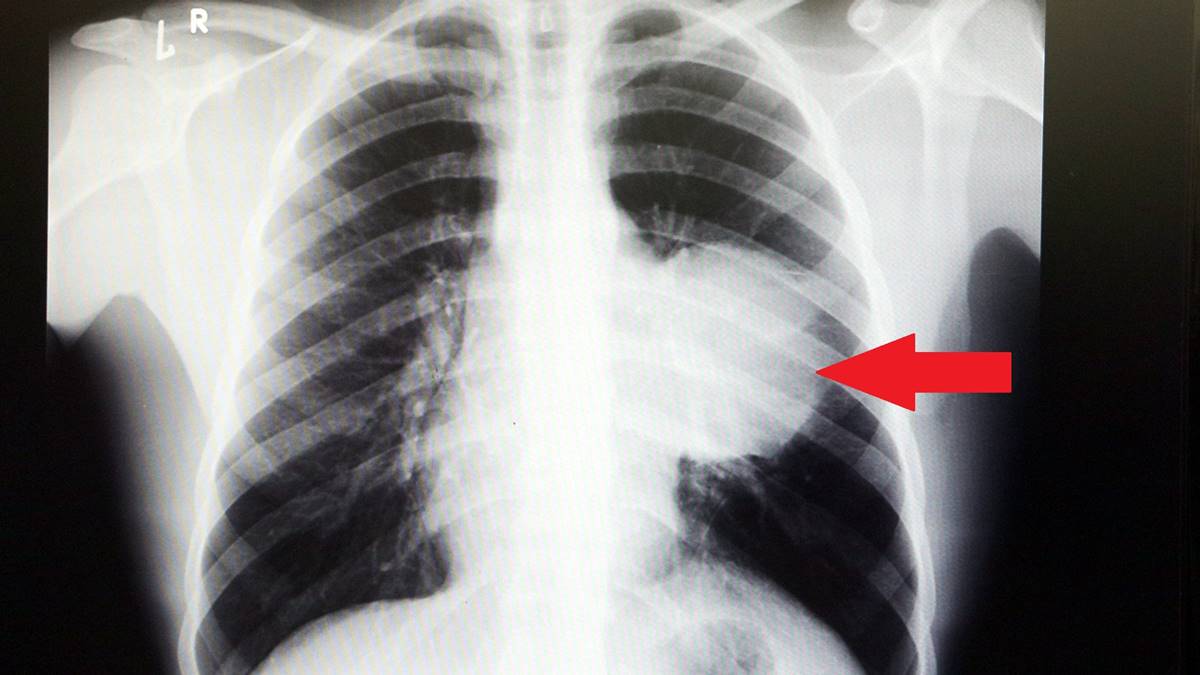 kalbi-12-santim-saga-kaydi-dev-tumor-doktorlari-bile-sasirtti-4
