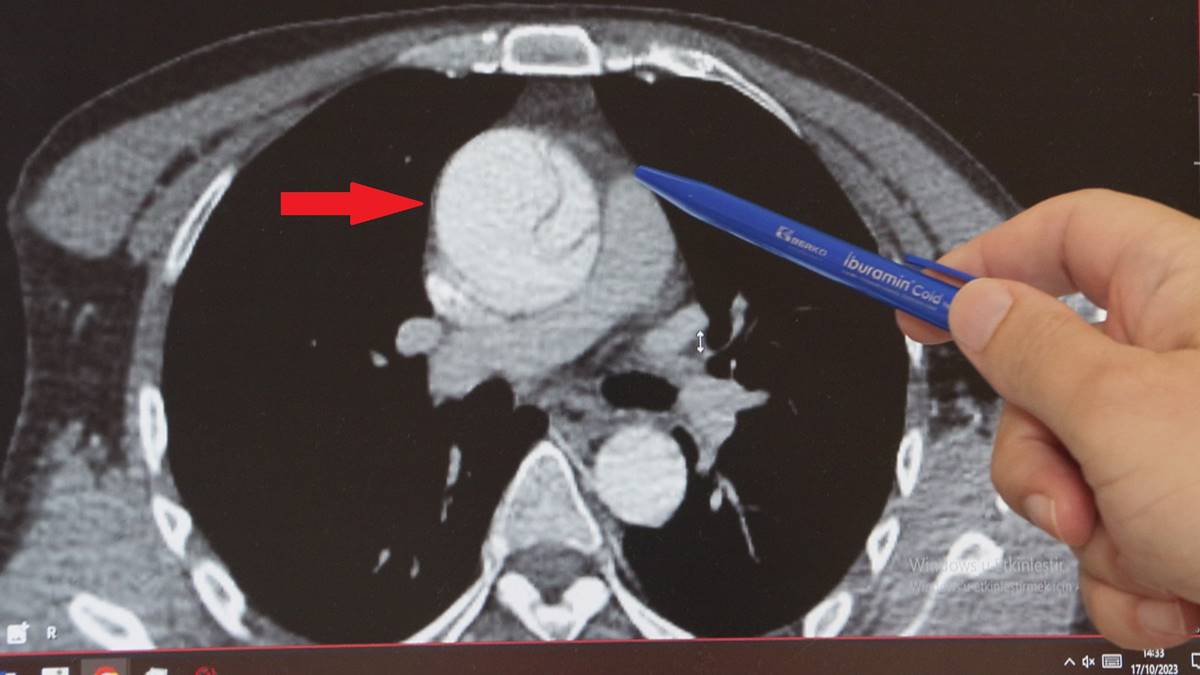 mide-agrisi-sandi-aort-damarinda-yirtik-cikti-1