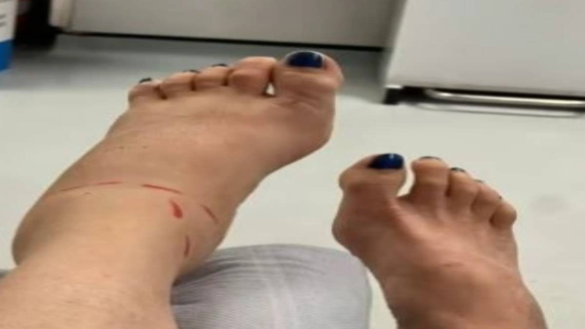 dunyanin-en-zehirli-yilani-o-ilimizde-goruldu-genc-kadini-oyle-bir-yerinden-isirdi-ki-gordugunuz-gibi-kacin