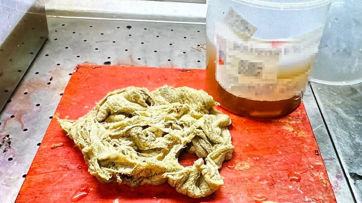 dogum-yapan-kadinin-karninda-unutulan-sey-sok-etti-2-yil-boyunca-karninda-onunla-yasamis-agrilari-artinca-farkedildi