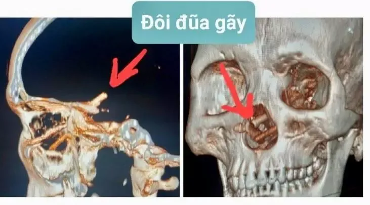 burnundan-beynine-cubuk-saplanmis