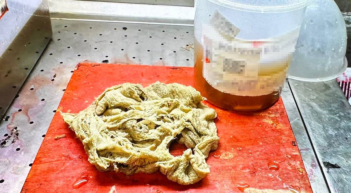 hastanin-vucudunda-yabanci-cisim-birakilmasi-cezasi-ne-kadar-3