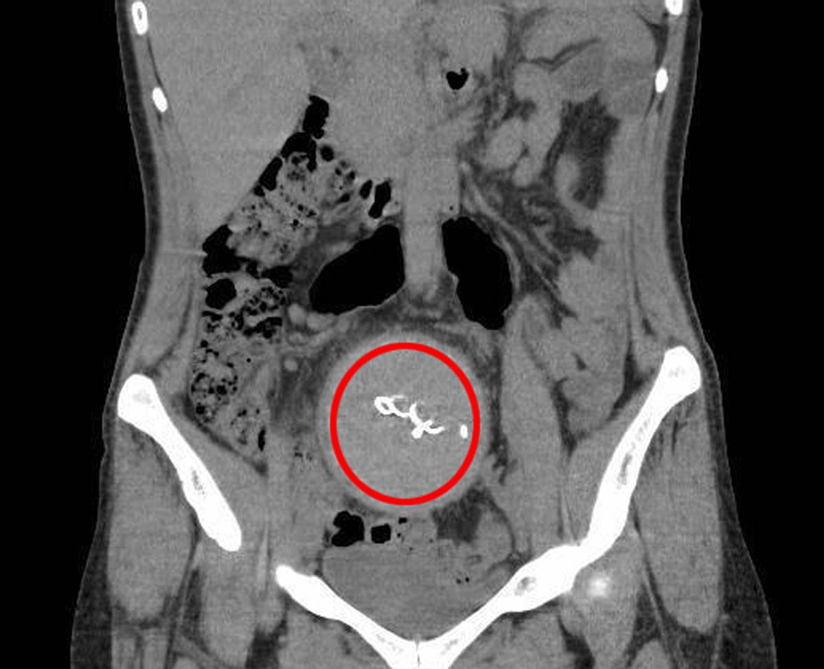hastanin-vucudunda-yabanci-cisim-birakilmasi-cezasi-ne-kadar-4