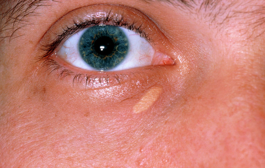 xanthelasma-deposit-on-lower-eyelid-dr-p-marazziscience-photo-library-001.jpg