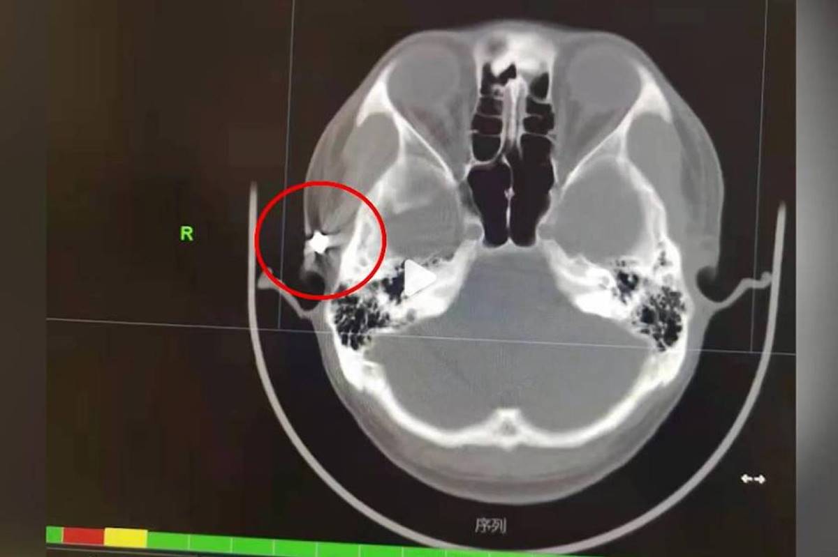 20-yildir-basi-agriyan-adamin-kafasinda-mermi-bulundu