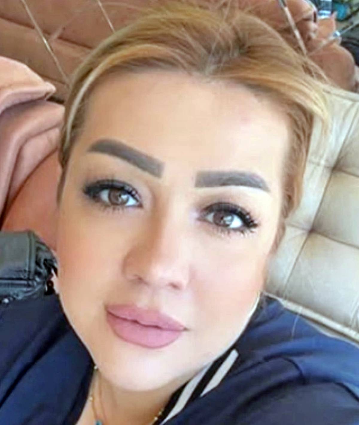 estetik-faciasi-hatali-yanlis-botoks-ornegi-5.jpg