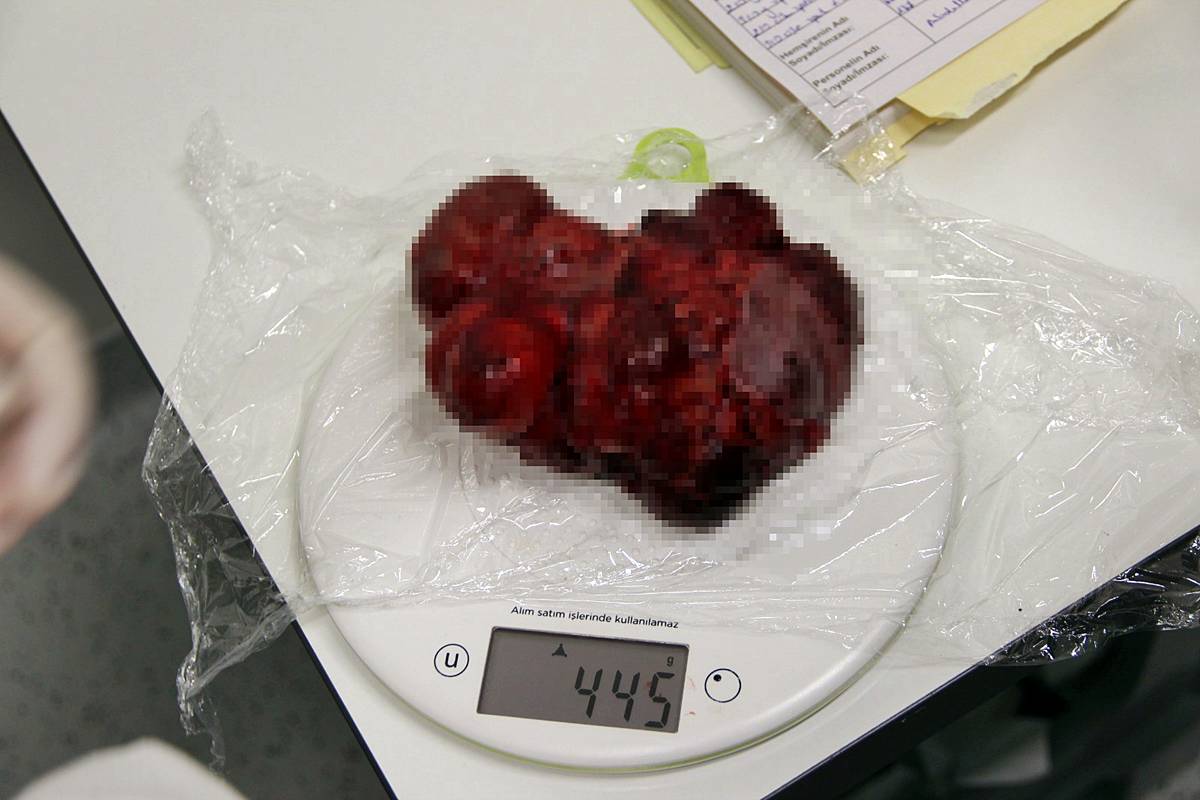 yeni-dogan-bebekte-tumor-olur-mu-bebekte-tumor-nasil-tedavi-edilir-2.jpg