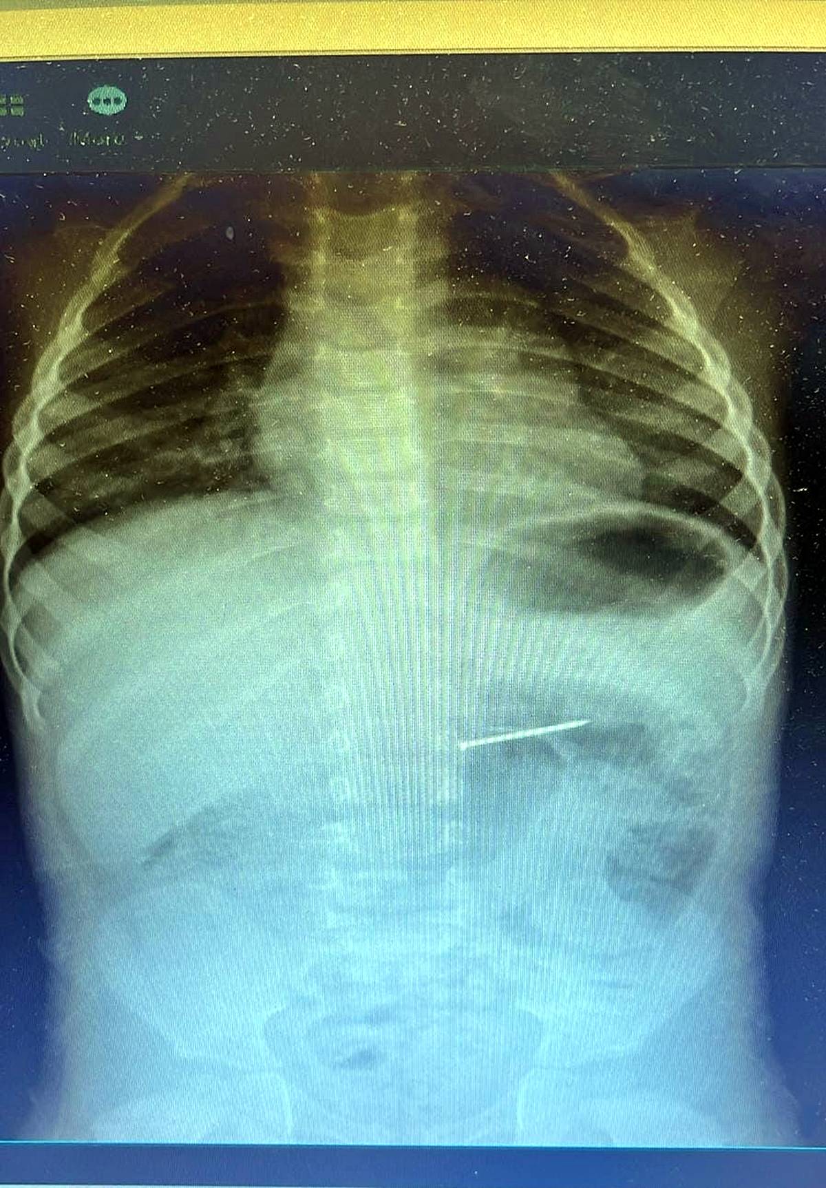 cocuk-civi-yutarsa-ne-yapilir-1