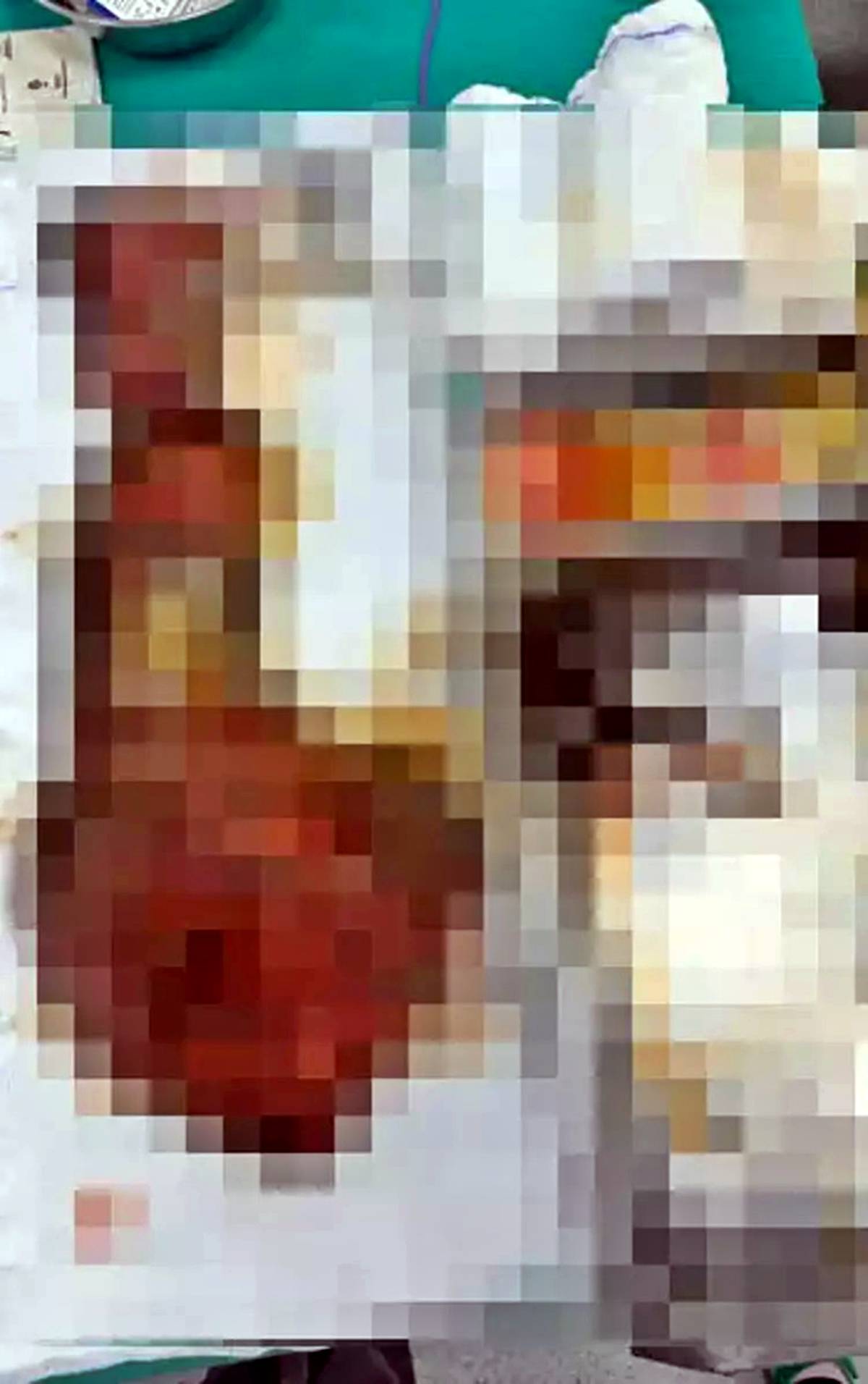karacigerinden-90-santimetrelik-kedi-kopek-kisti-cikarildi-2.jpg