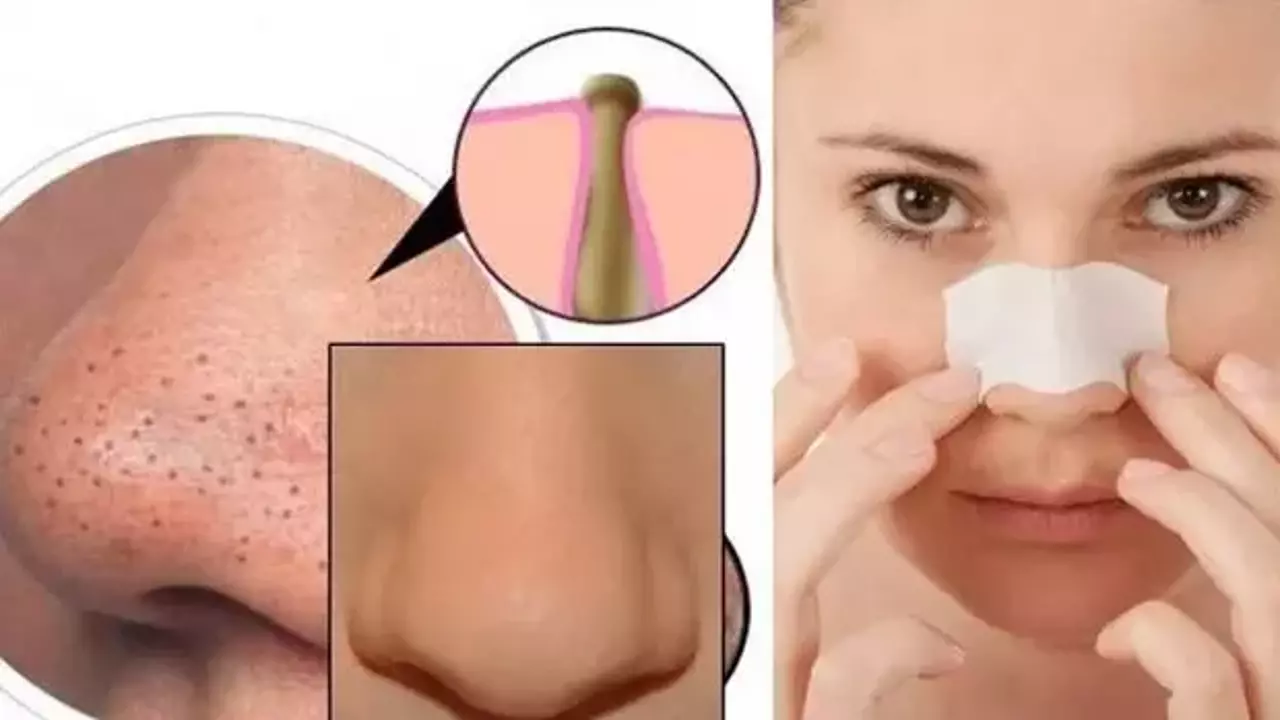 evde-siyah-nokta-temizleme-kesin-cozum-dogal-siyah-nokta-maskeleri-1545034940-8874