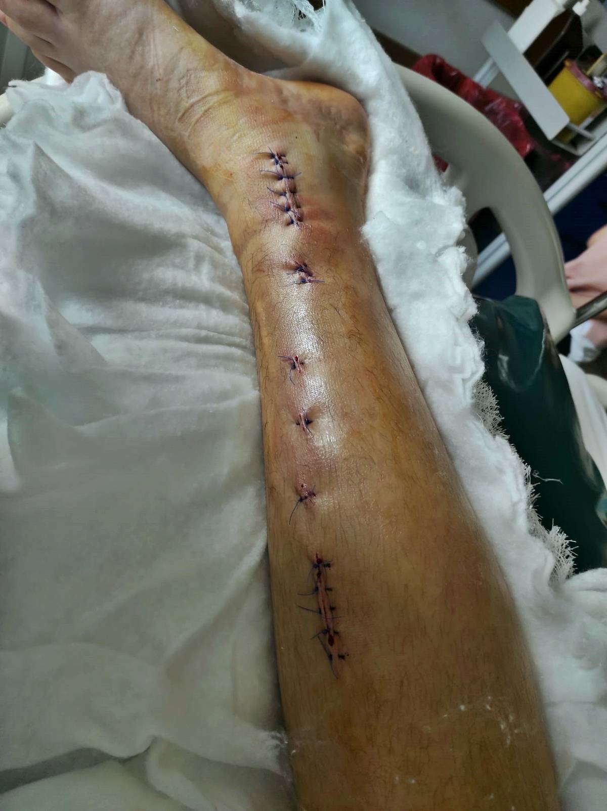 samsun-ozel-okulda-akran-zorbaligi-ogrencinin-ayagi-kirildi-7