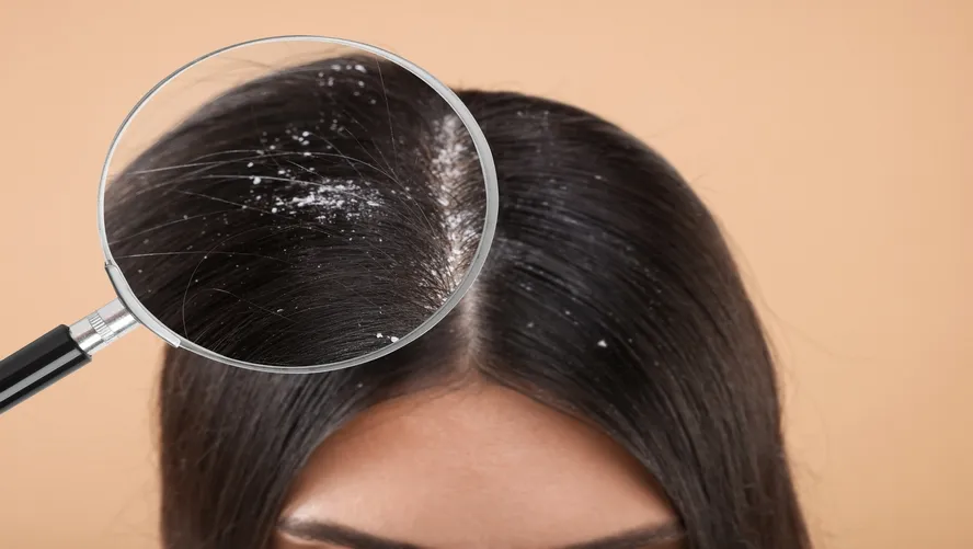 evde-kepek-nasil-gecer-ne-iyi-gelir