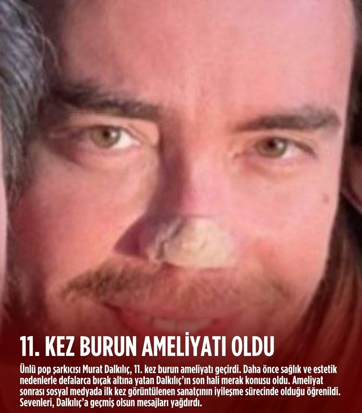 murat-dalkilic-kec-kez-burun-ameliyati-oldu