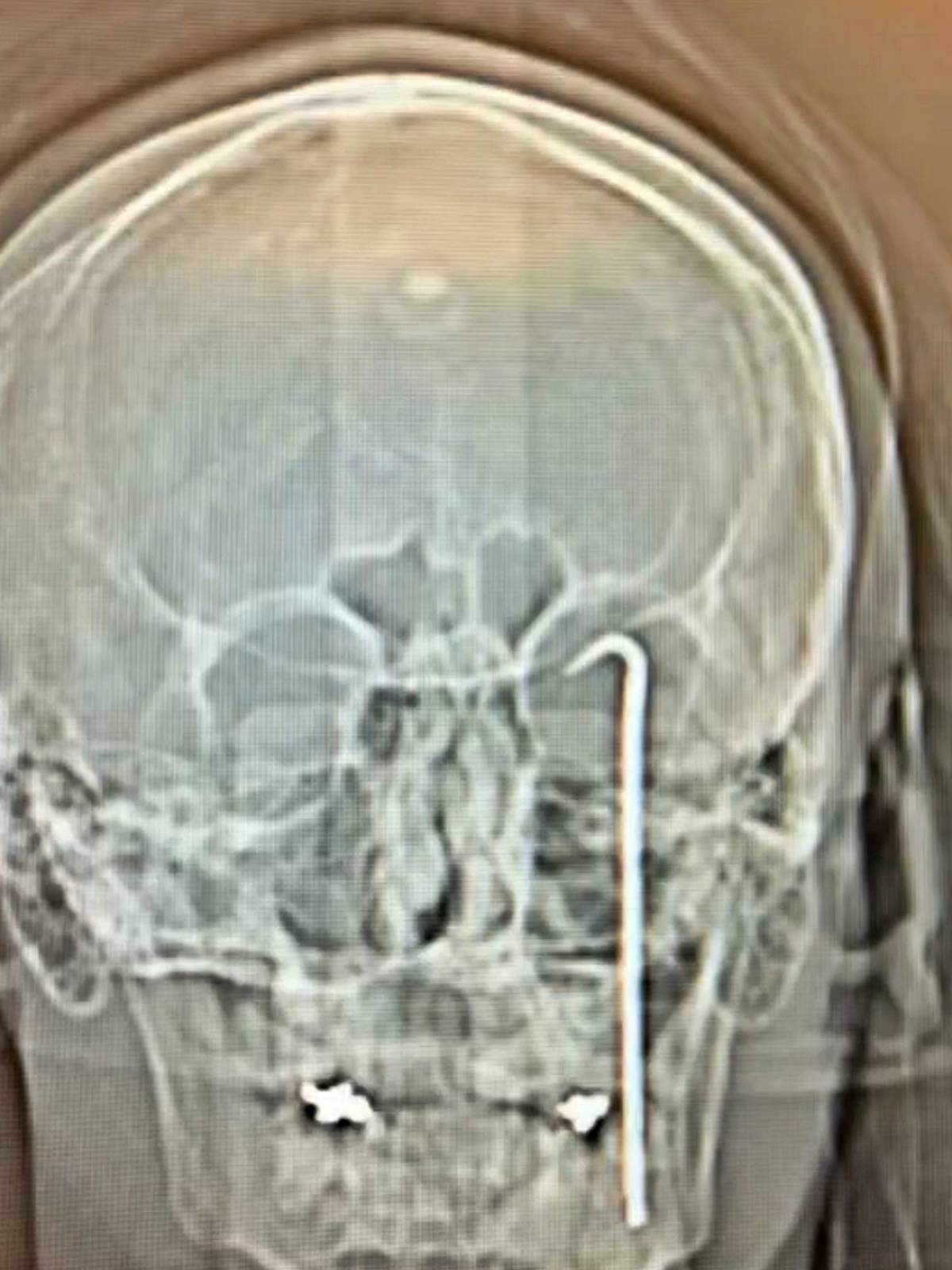 is-kazasi-tornavida-gozune-saplandi-1